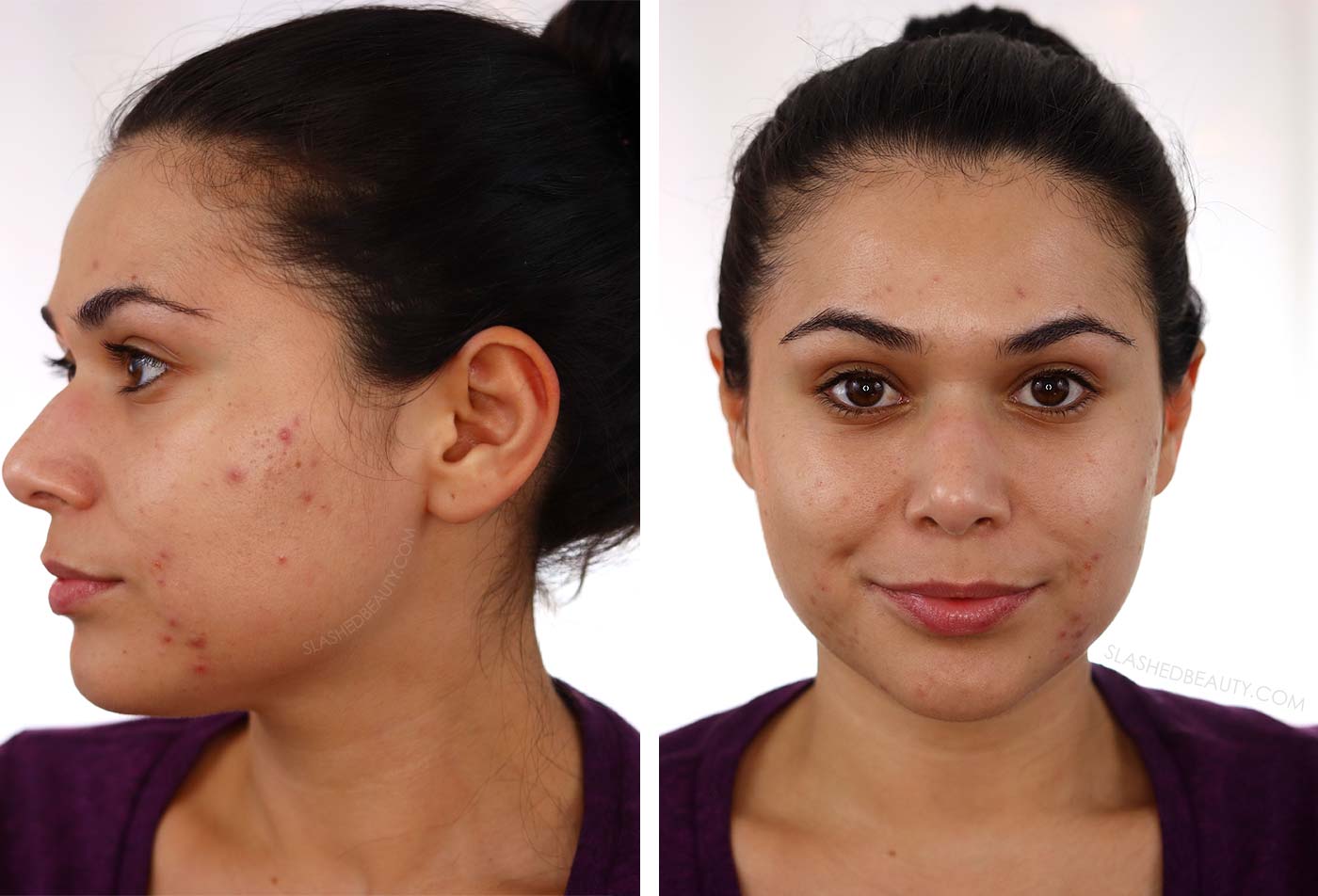 before-going-dairy-free-for-acne | Slashed Beauty BEFORE Going Dairy Free for Acne: My 30 Day Results | Does Going Dairy Free Help with Acne? | Slashed Beauty