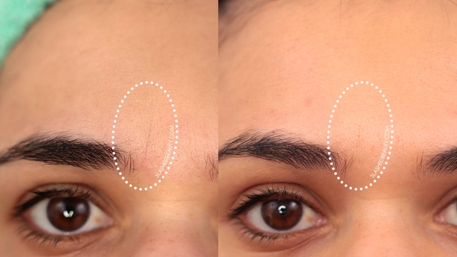 solawave-frown-lines-before-after | Slashed Beauty Solawave Before & After Results: Frown Lines / Elevens with noticeable fading after 30 days| SolaWave Skin Care Wand Review | Slashed Beauty