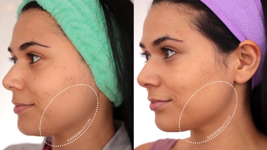 solawave-jawline-before-after | Slashed Beauty Solawave Before & After Results: Jaw line more defined after 30 days | SolaWave Skin Care Wand Review | Slashed Beauty